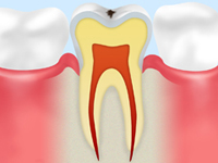 虫歯の兆候