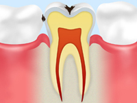 初期の虫歯