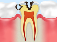 中期の虫歯