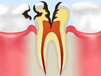 中期以降の虫歯