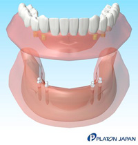 インプラントオーバーデンチャー